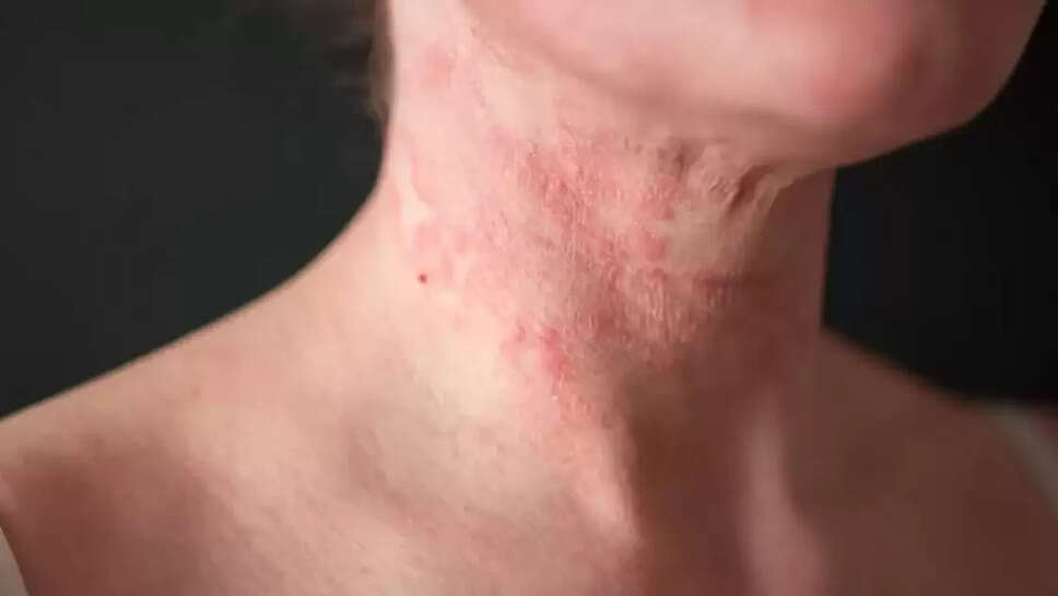 Skin rashes